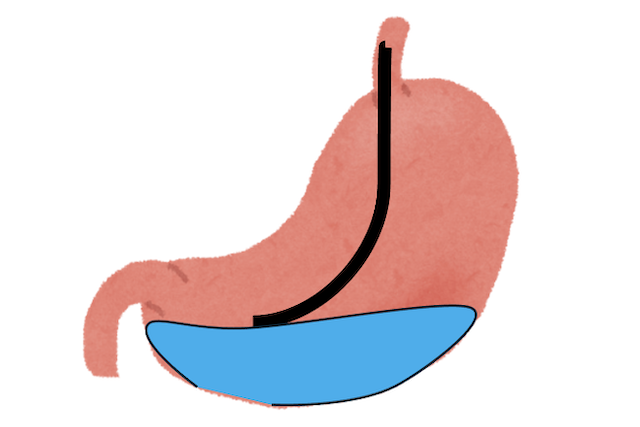 下剤を飲まない大腸内視鏡